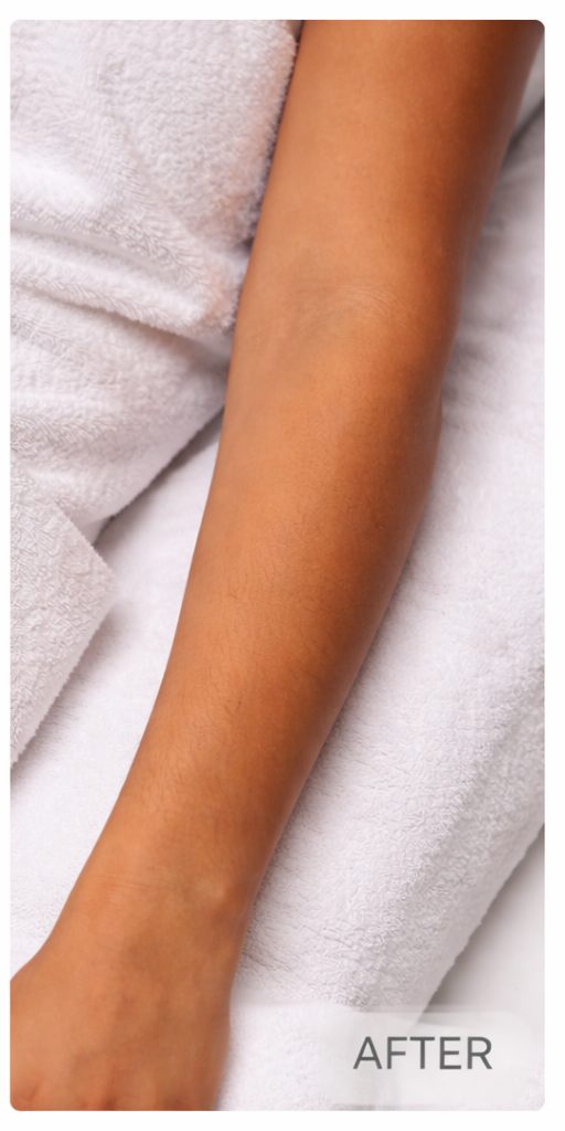 After arm laser hair removal on darker skin tone at Aroma Waxing & Laser Clinic