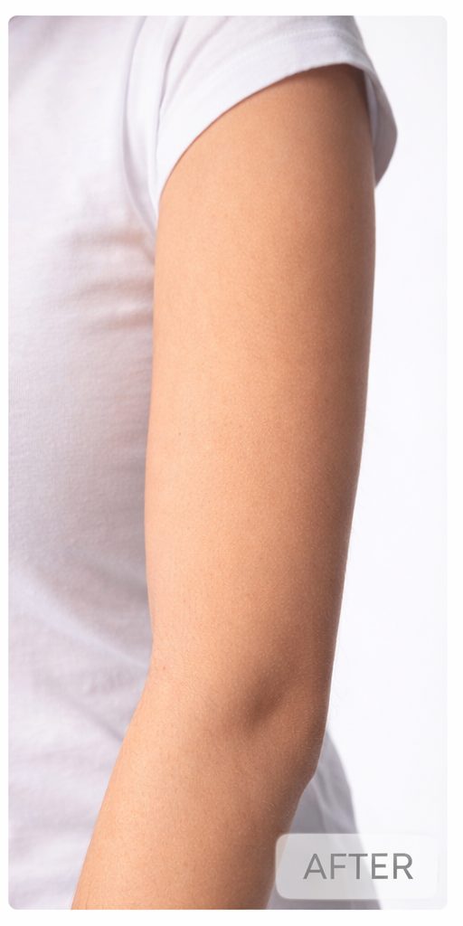 After arm laser hair removal result on light skin tone at Aroma Waxing & Laser Clinic