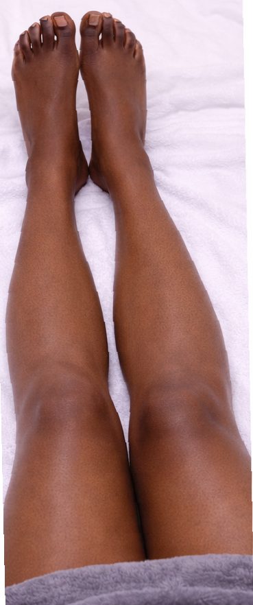 After leg laser hair removal on dark skin showing smoother lower legs with reduced hair