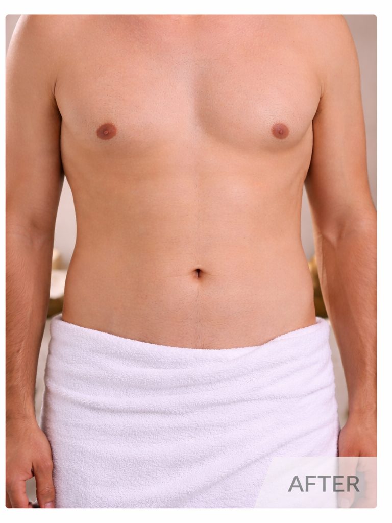 After stomach and chest laser hair removal result showing smoother torso hair reduction