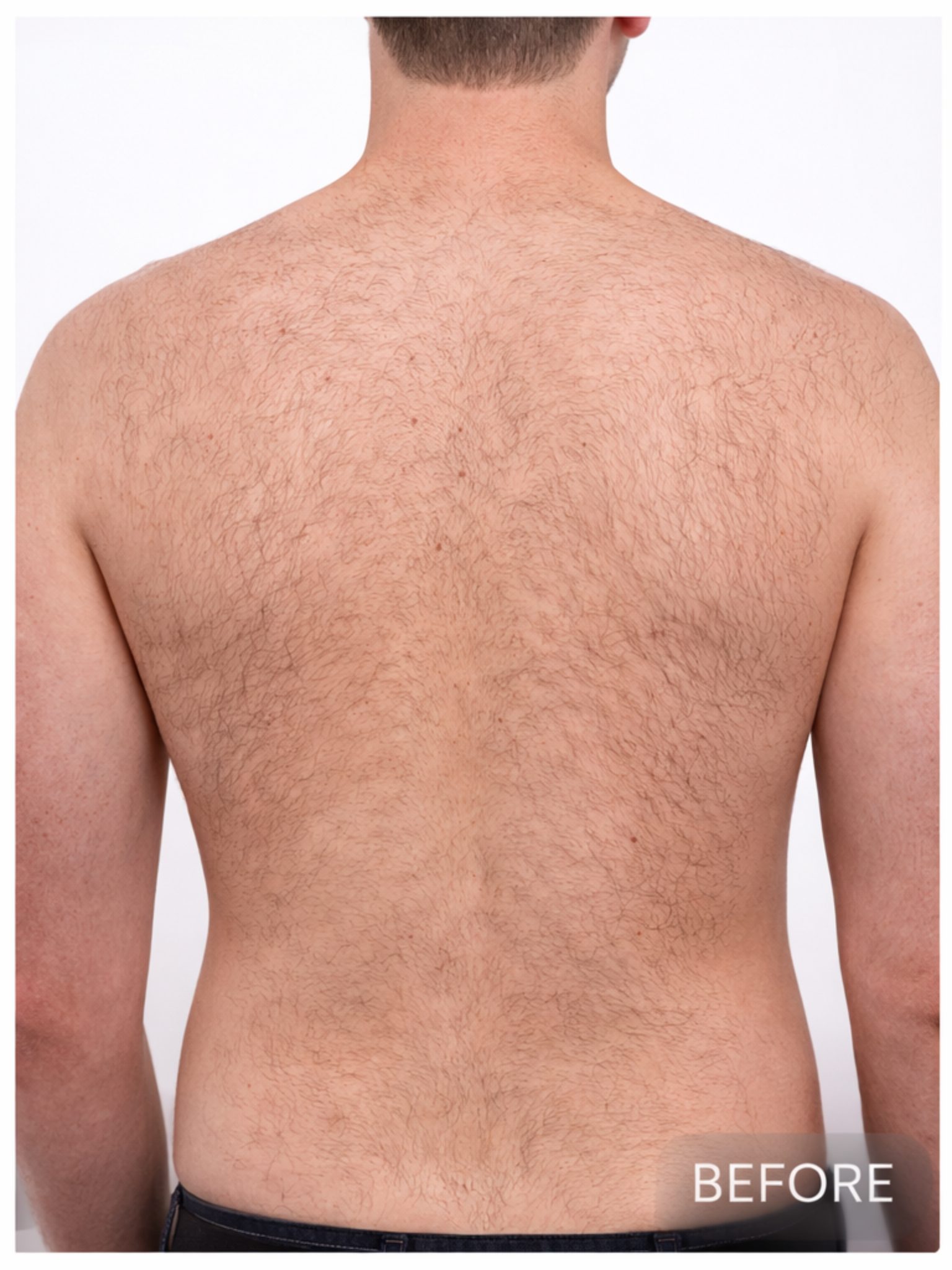 Back laser hair removal before photo on a light skin male back