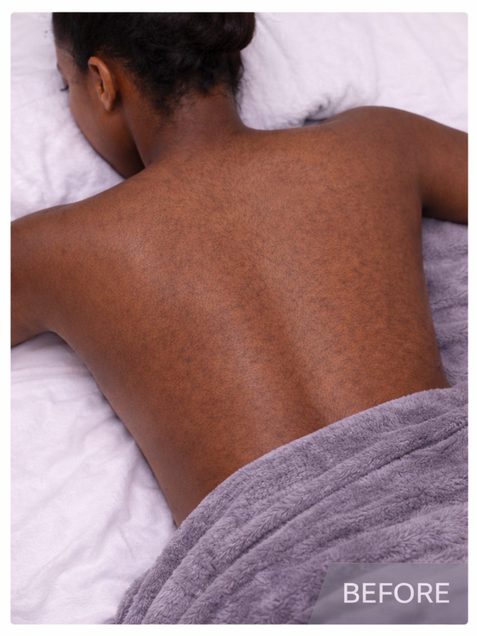 Back laser hair removal before photo on darker skin lower back