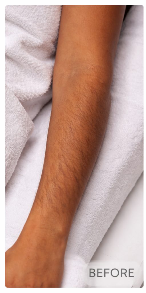 Before arm laser hair removal on darker skin tone at Aroma Waxing & Laser Clinic
