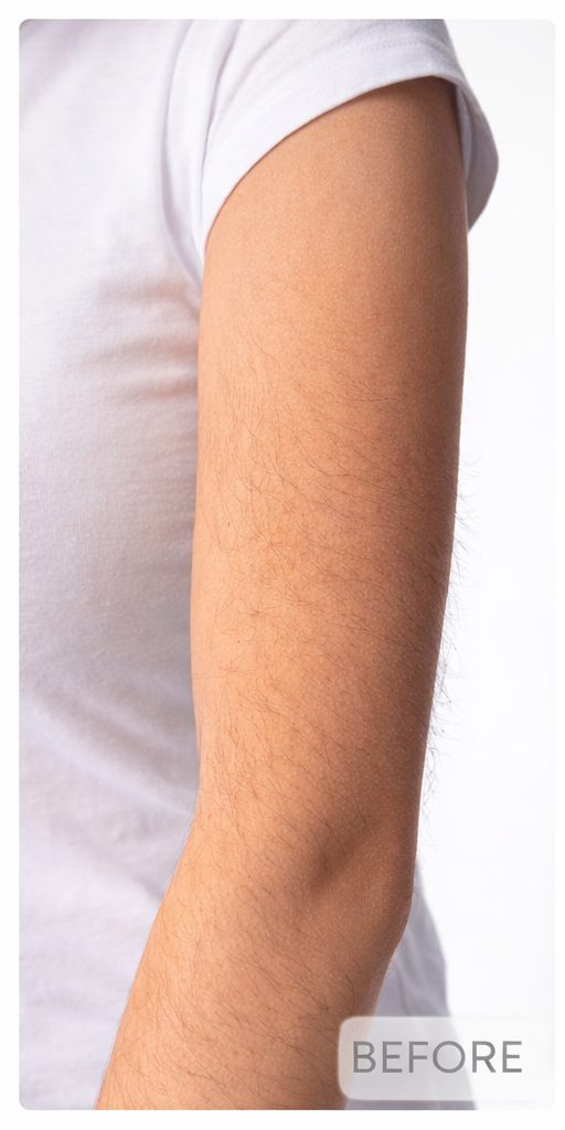 Before arm laser hair removal on light skin tone at Aroma Waxing & Laser Clinic