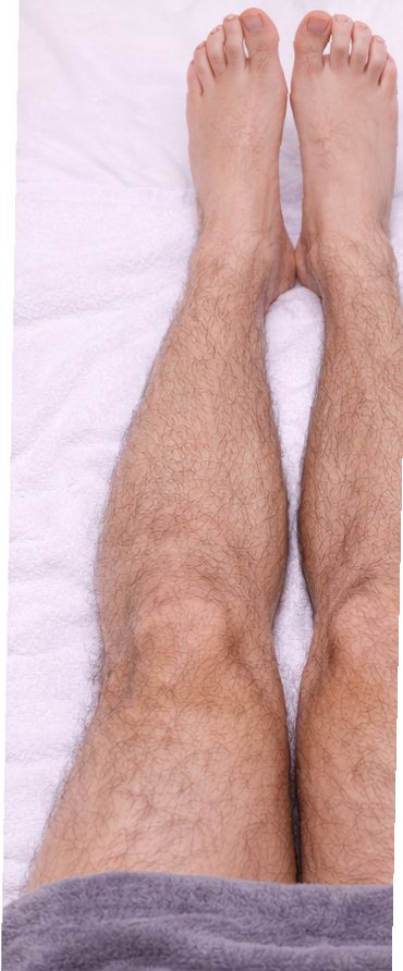 Before leg laser hair removal on light skin showing visible lower leg hair