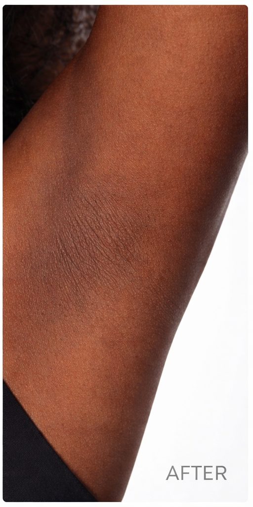 Underarm after laser hair removal on dark skin
