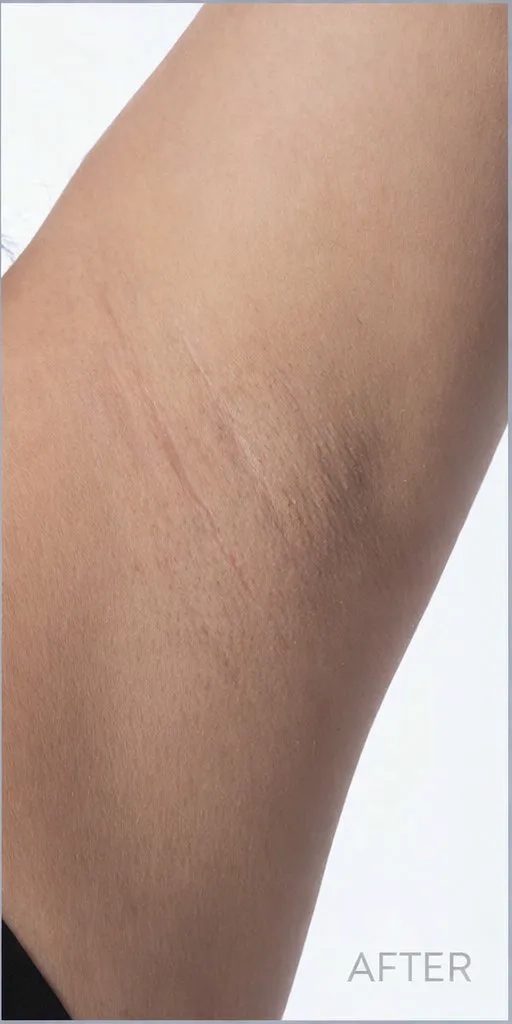 Underarm after laser hair removal on light skin