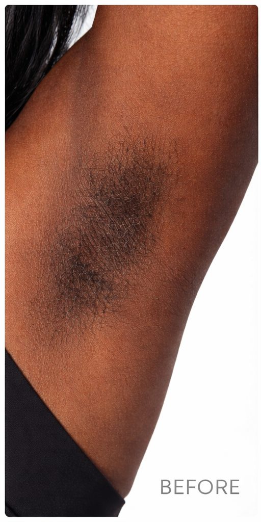 Underarm before laser hair removal on dark skin