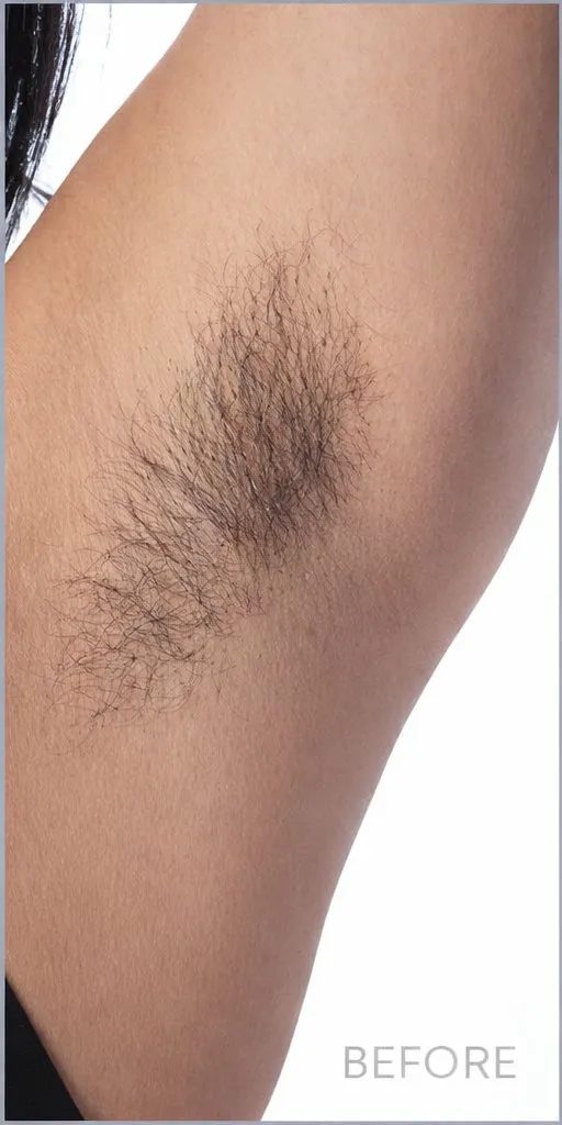 Underarm before laser hair removal on light skin